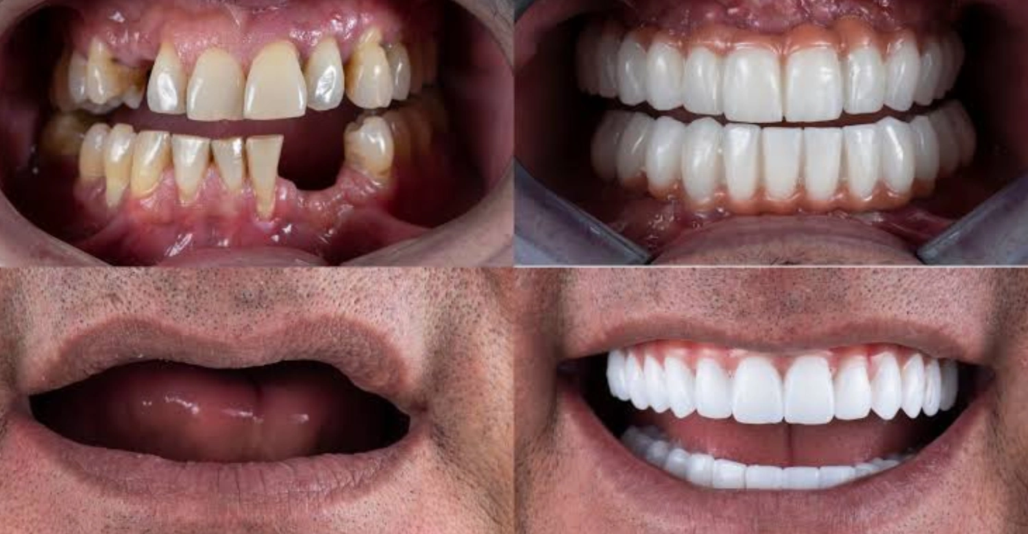 Full Mouth Dental Implants In blog
